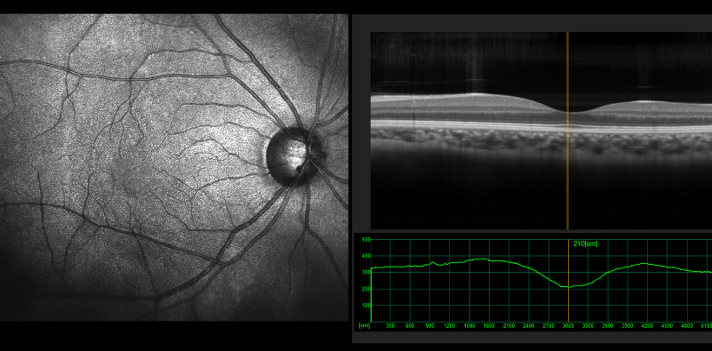 Optical coherence tomography scan results, showing the retina and a cross section of the eye.